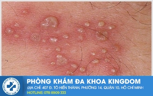 Nguyên nhân gây nổi mụn dương vật