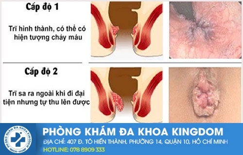 trĩ nội cấp 1, 2