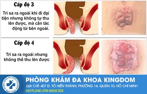 Trĩ nội cấp độ 3, 4
