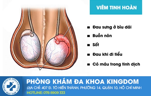 Cách điều trị viêm tinh hoàn